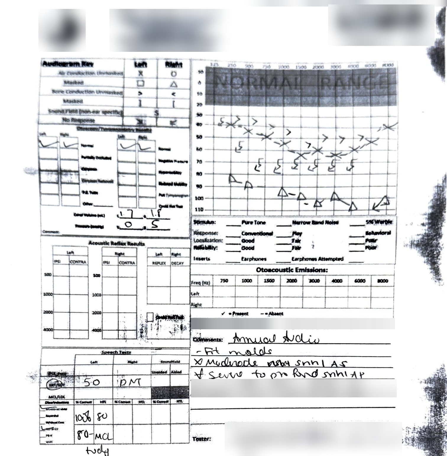 A scanned paper audiogram form. The graph shows left ear X symbols between about 40 and 65 dB and right ear triangles between about 80 and 105 dB, with bone conduction and no-response symbols, next to tympanometry, speech test and comment sections. The letterhead, barcode, document ID, print stamp and tester signature are blurred.